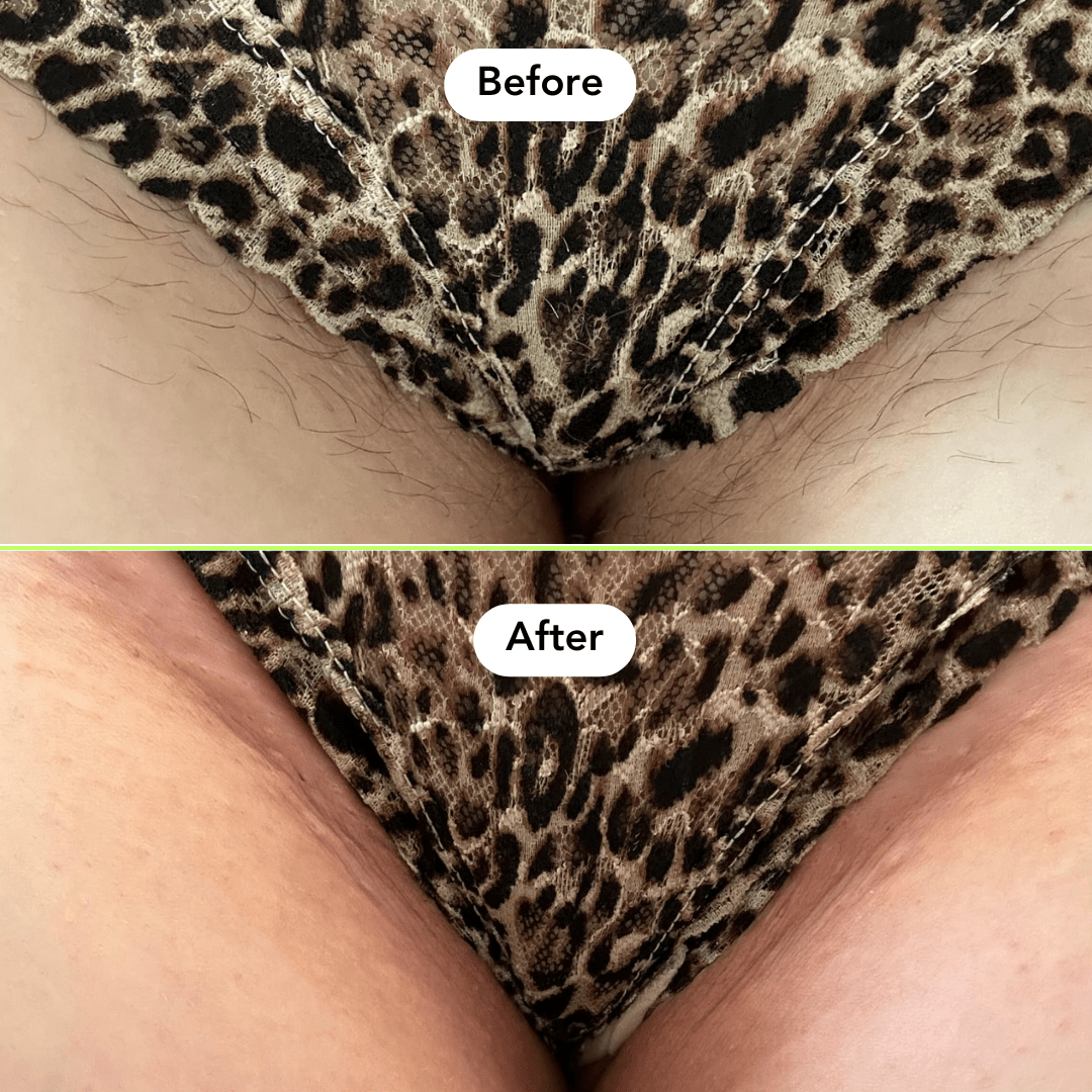 Bikini Hair Removal Jar