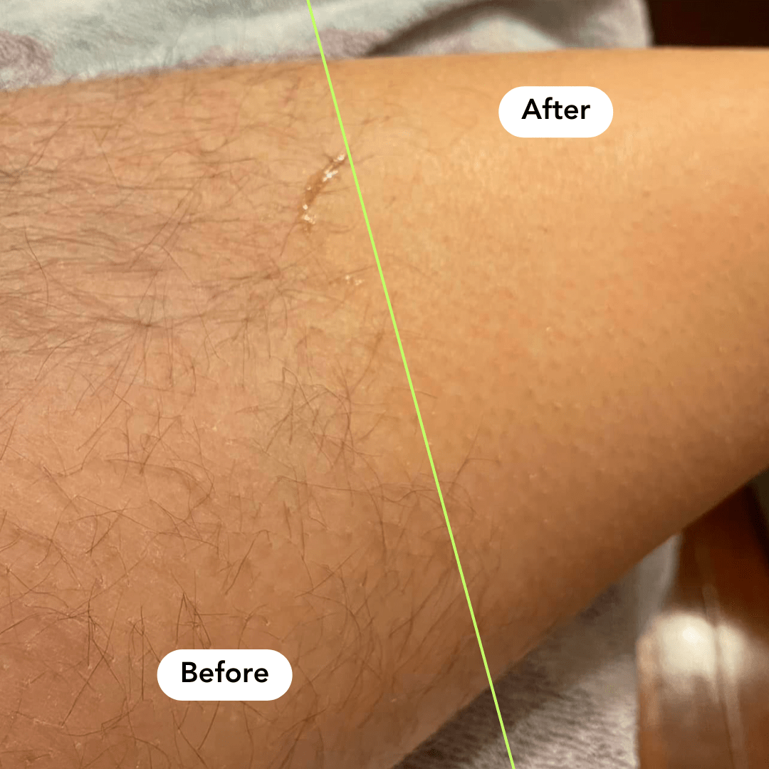 Premium Hair Removal & Smooth Skin Regimen