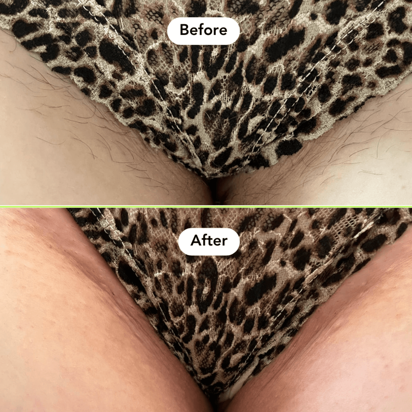 Bikini Hair Removal Kit