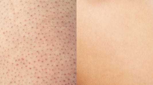 What are Strawberry Legs? and How to Fix Them!